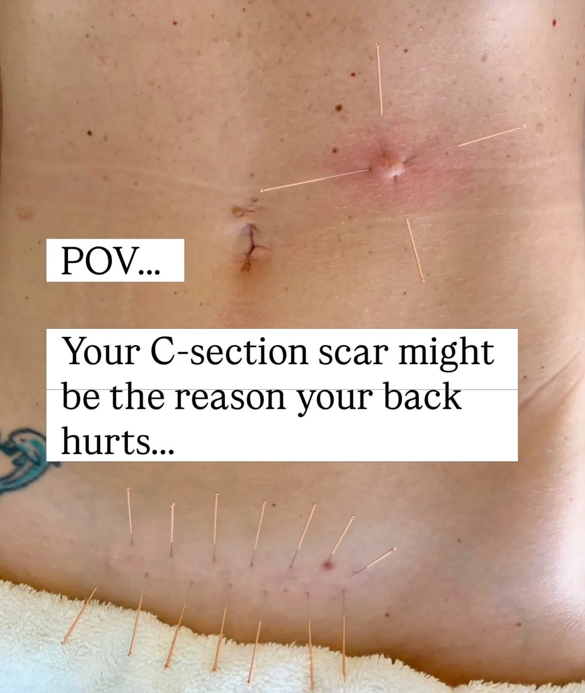 POV&hellip; Your client comes in with low back pain and you know they have multiple abdominal scars.. 

Here&rsquo;s your reminder:
✨ Just because a scar looks healed&hellip;
doesn&rsquo;t mean it&rsquo;s functioning well.

Scars can disrupt:
&ndash;