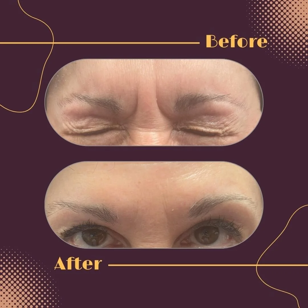 Static 11 lines can be difficult to treat and we should not expect them to disappear completely, but they can be softened dramatically with neromodulator injections. 

Call, text, or DM me to schedule an appt. for your next Botox, Dysport, Jeuveau, o