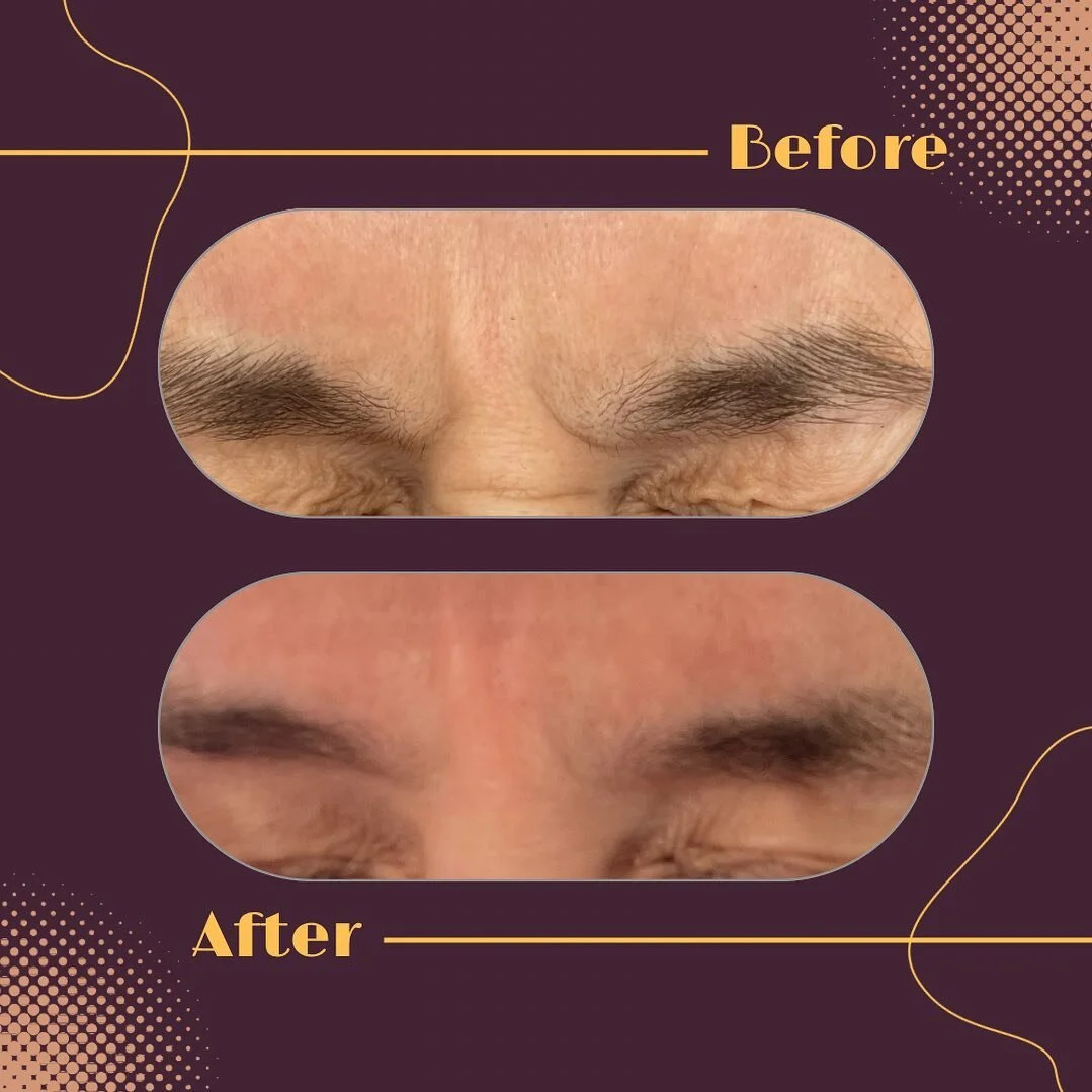 Brotox&hellip;
a colloquial term used to refer to the use of Botox injections by men. Originally, Botox was more popular among women seeking to diminish signs of aging, but over time, an increasing number of men have also embraced this cosmetic proce