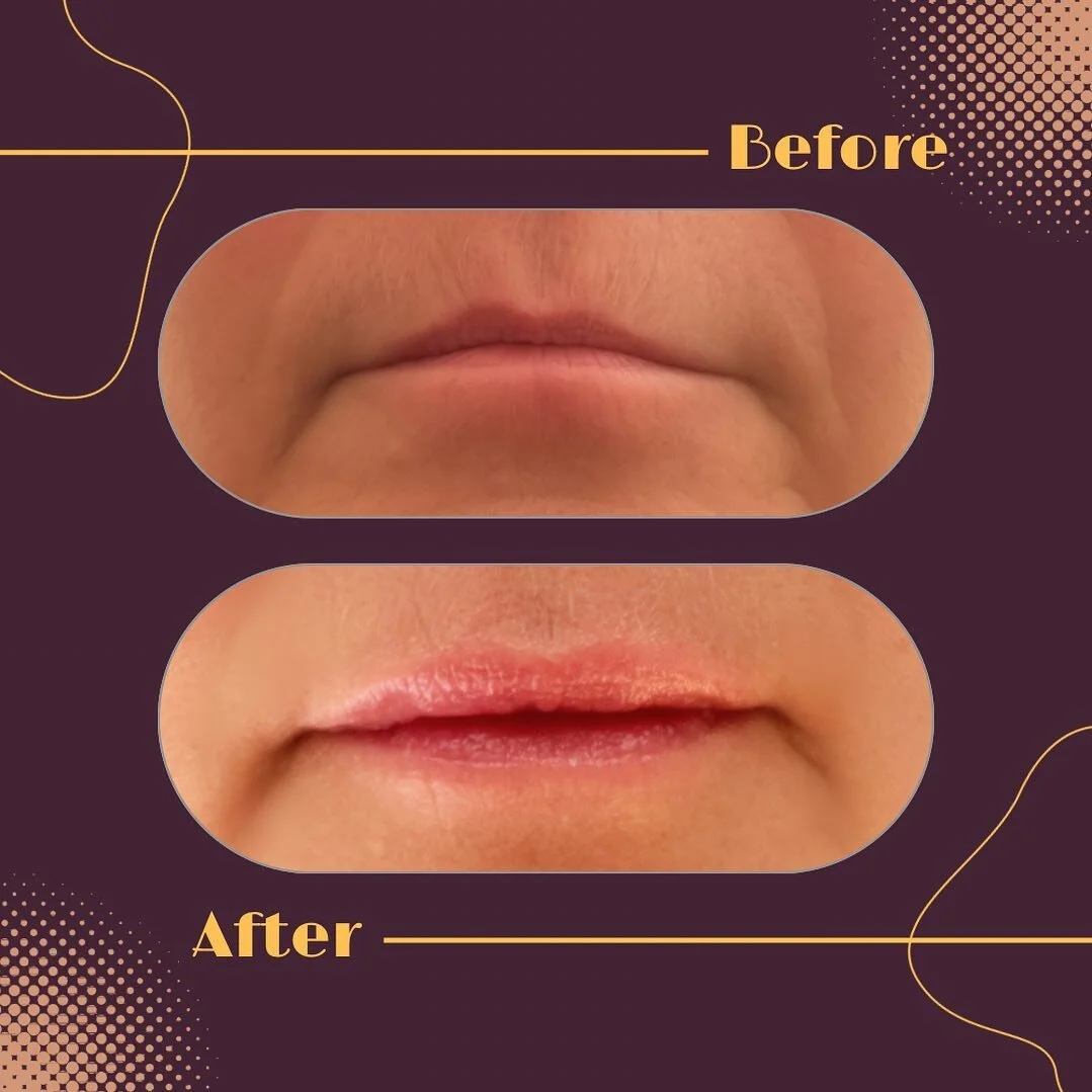 Just taking some lip filler out for a little spin before committing to a whole syringe&hellip;sometimes subtle volume is all you want, but maybe you want more&hellip;.
Additional volume can be given, but best to wait a few weeks, allowing the injecte