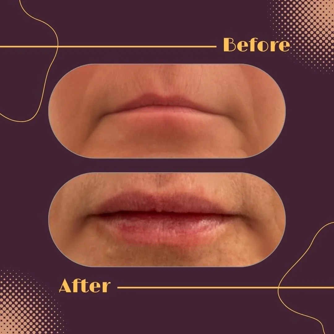 You're absolutely right! The term &quot;filler&quot; in the context of cosmetic procedures doesn't have to result in &quot;duck lips.&quot; Filler treatments, such as dermal fillers, are used to enhance and rejuvenate various facial features without 