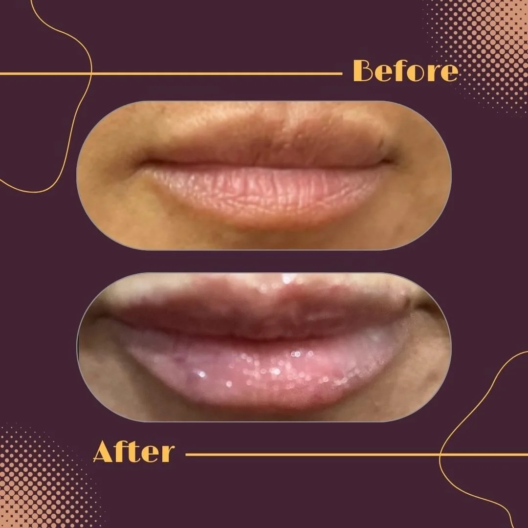 What a little volume looks like....subtle and natural.

#versa #revannesseversa #restylanelips #xeomin&reg; #botox #luna_visage_de #neuromodulator #nurseinjector #aestheticinjector #dysport&reg; #jeuveau&trade; #conciergeinjectables #wilmingtondelawa