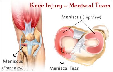 knee-injury-meniscus.jpg
