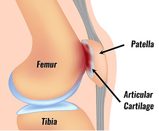Patellofemoral-Pain-Syndrome.png