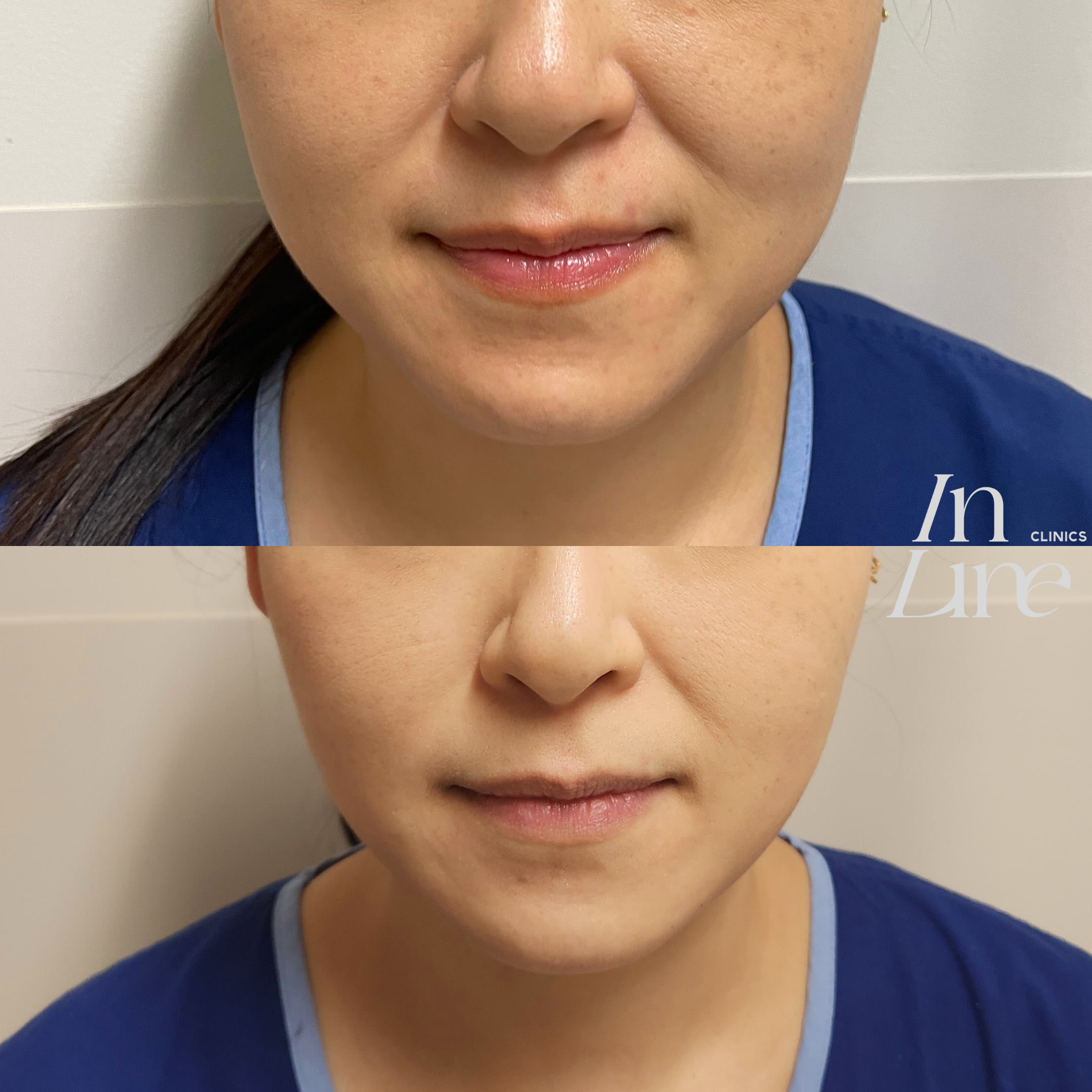 Anti Wrinkle Injection Canberra - Before & After 4