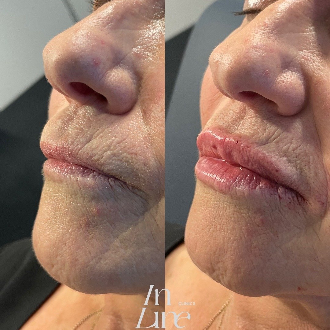 With a range of advanced techniques and premium lip fillers, we can sculpt and define your lips to perfection. From enhancing volume to improving symmetry, our treatments are designed to accentuate your natural beauty.

Book your consultation today a