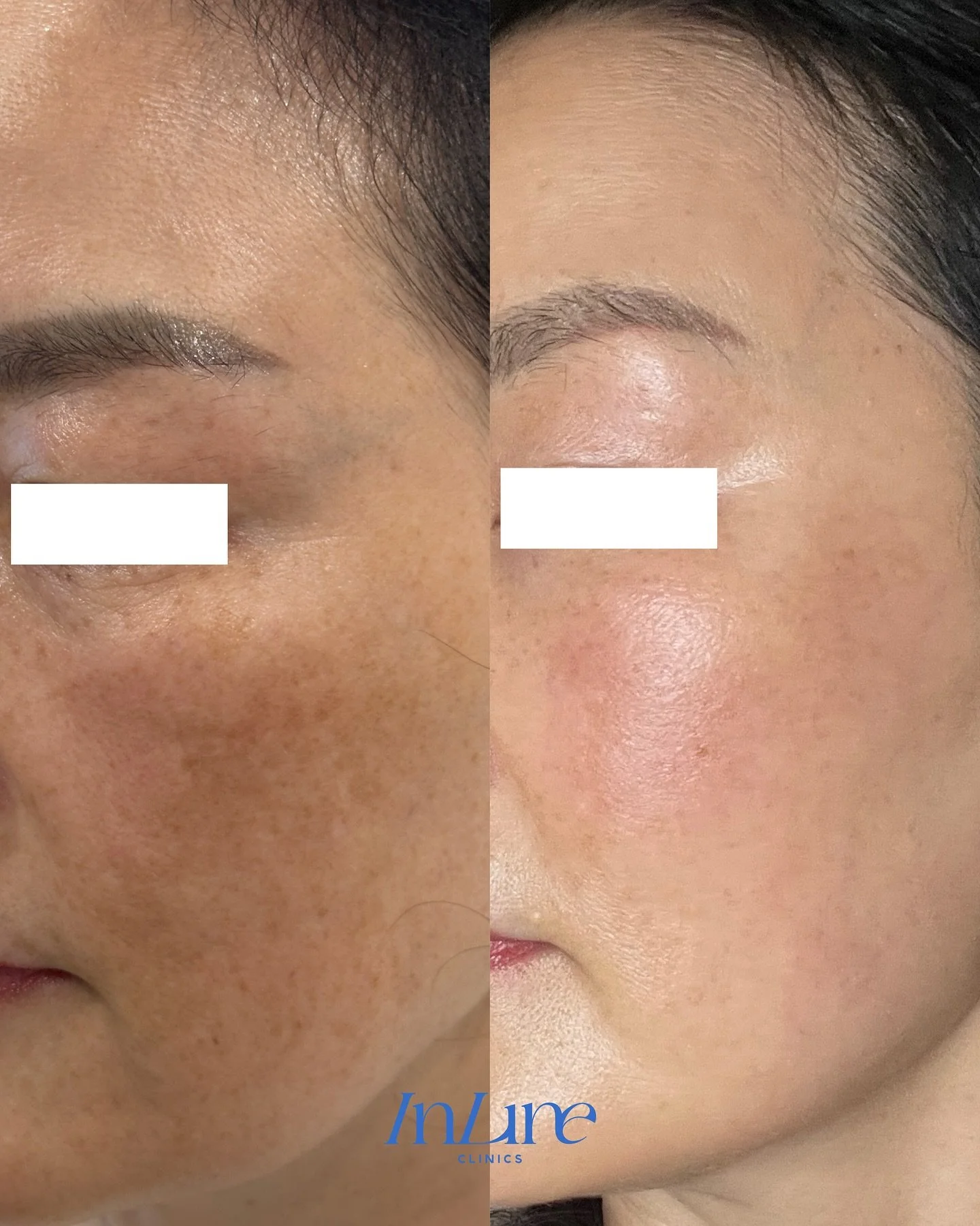 A real example of skin brightening ✨
This client received a personalised treatment plan to address skin discolouration, including stubborn melasma. After multiple sessions, we’ve seen a visible improvement in her overall skin tone.
Each treat