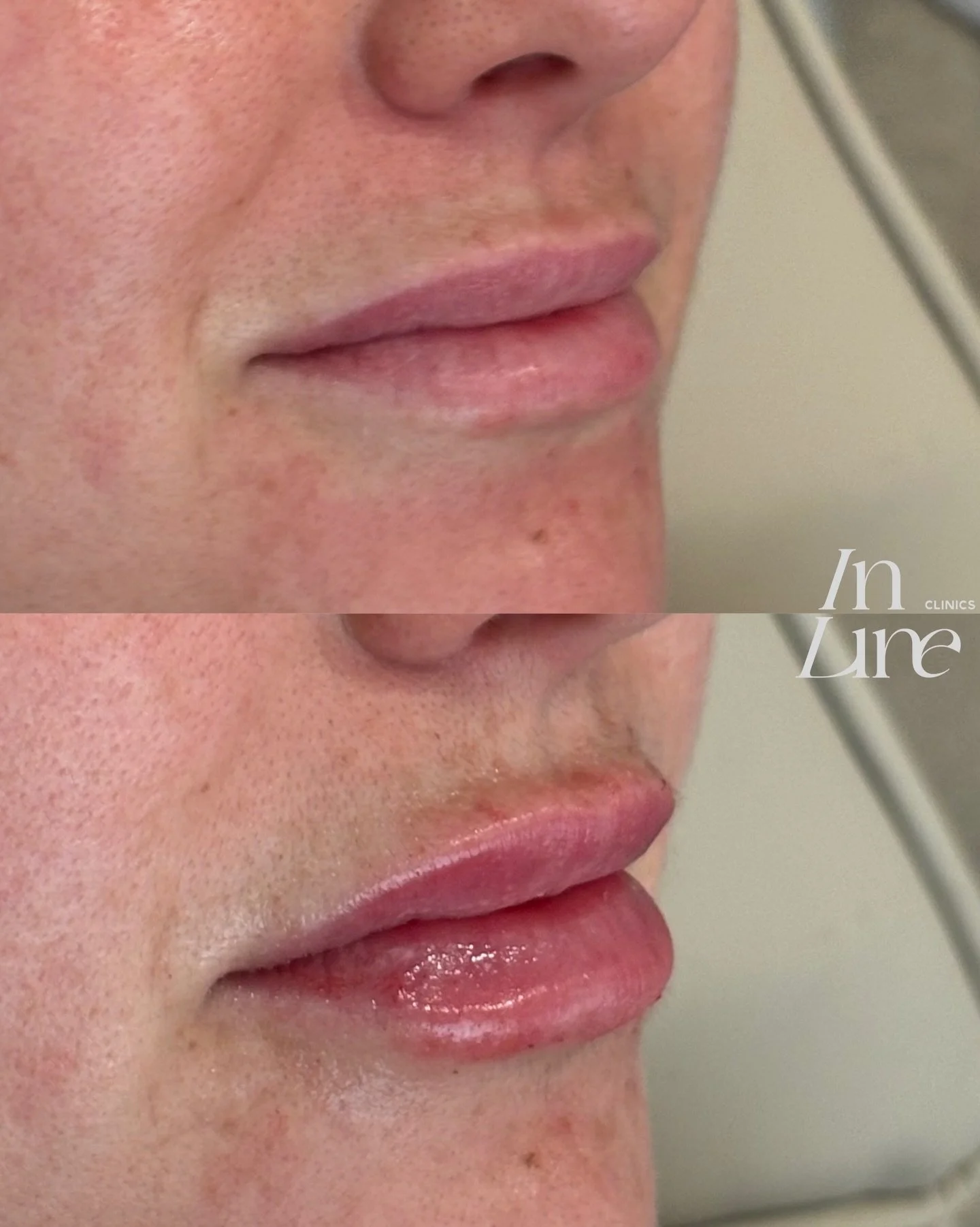 A soft, naturally refined lip enhancement &mdash; fresh, balanced, and beautifully understated for the festive season ✨
A simple way to feel a little more polished for the celebrations ahead 🎄

If you&rsquo;re planning any treatments before the holi