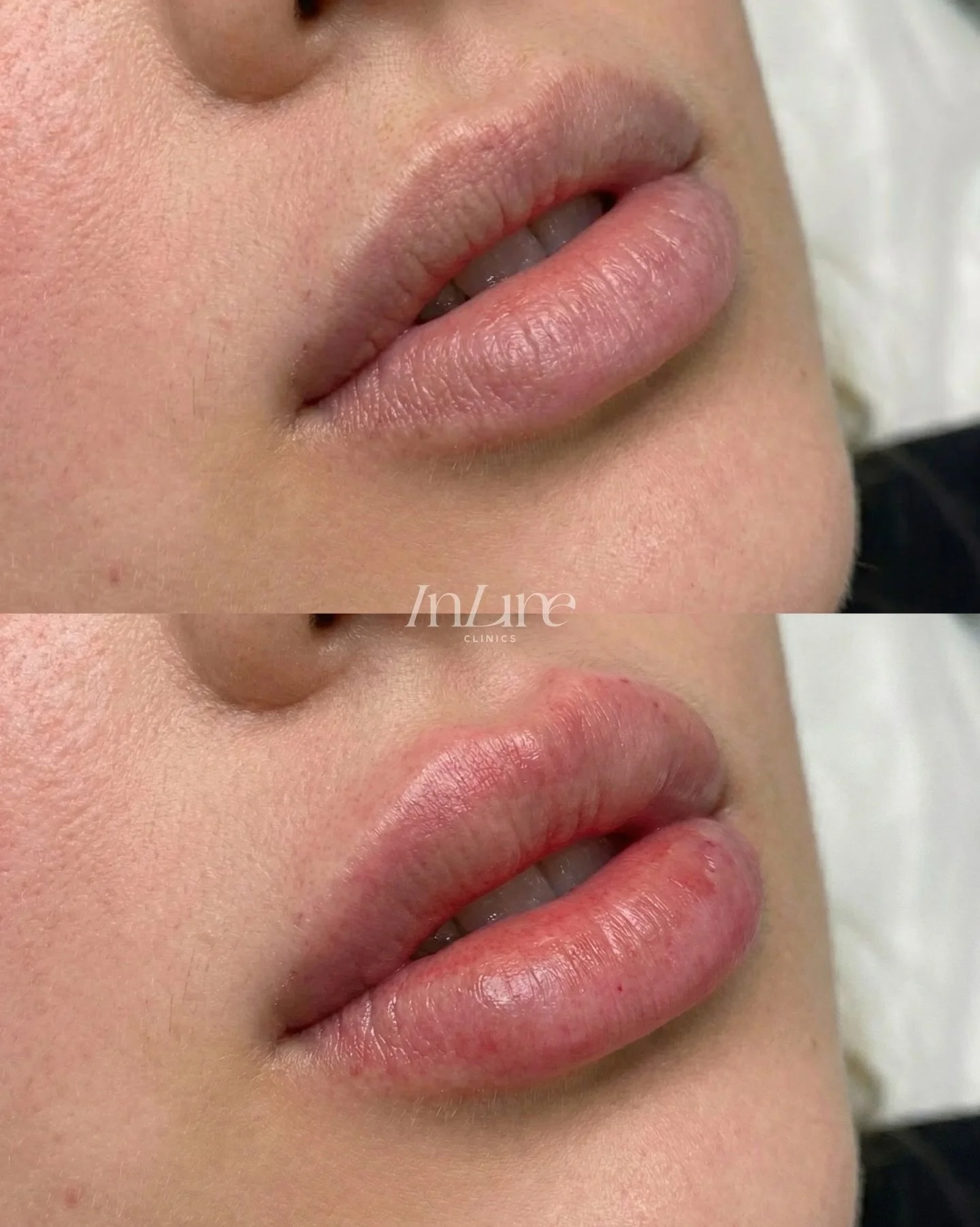 Most people think lip treatments are about making everything bigger.

But a lot of the time, it&rsquo;s just about balance.

Our client preferred a bit more volume in her upper lip,
so that&rsquo;s where we focused &mdash; rather than adding evenly.
