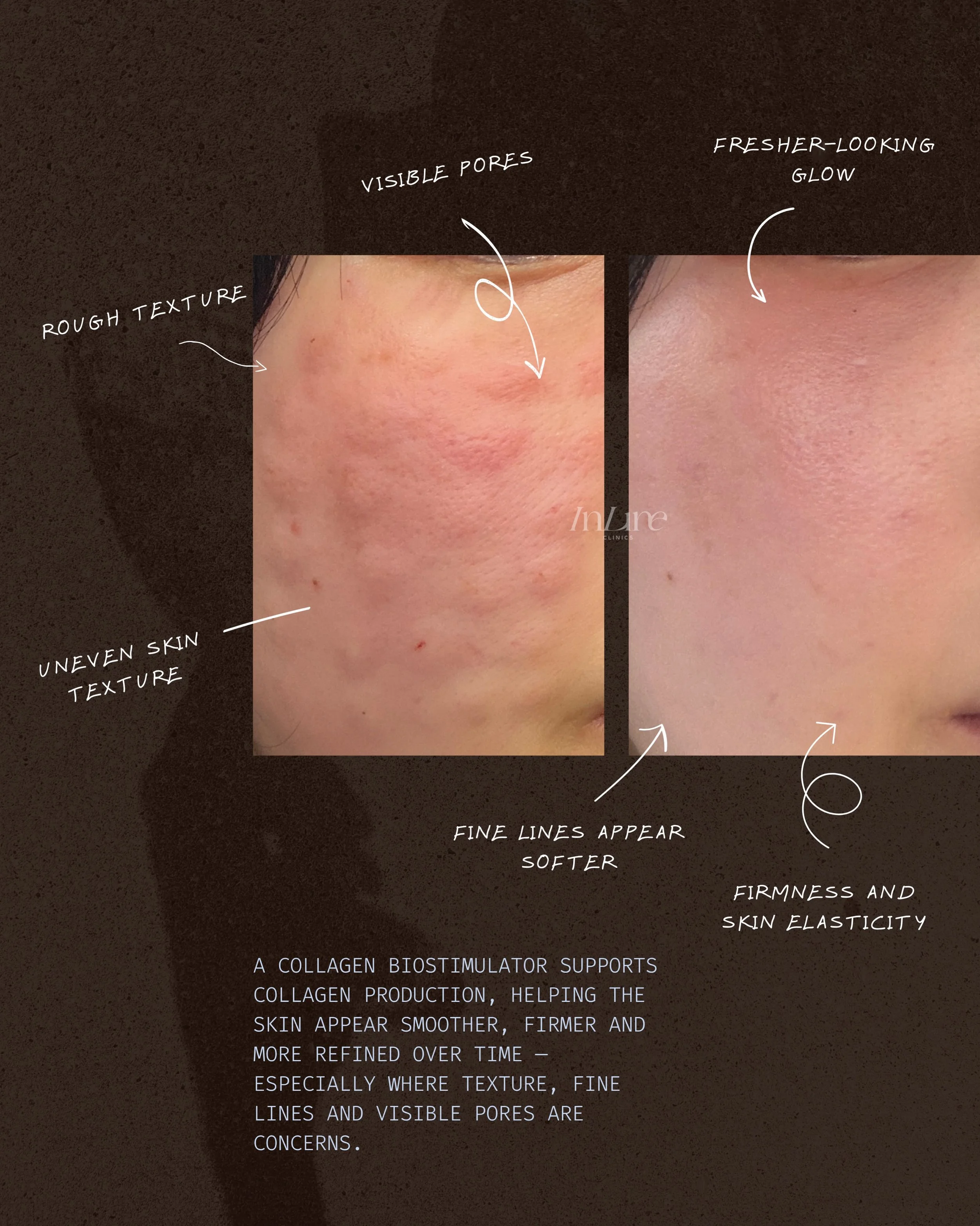 Skin quality, quietly refined.

A collagen biostimulator works by supporting your skin&rsquo;s natural collagen production over time, helping the skin appear smoother, firmer and more radiant.

Designed for those who love subtle, gradual improvements