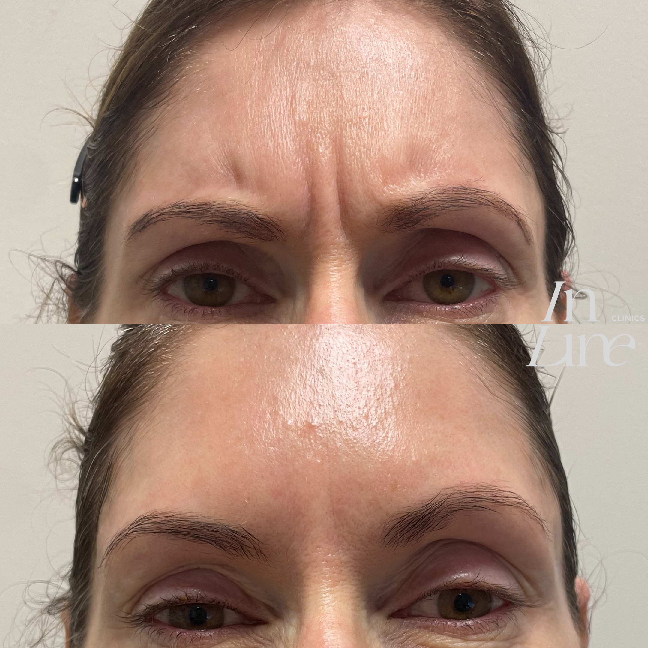 Anti Wrinkle Injection Canberra - Before & After 2