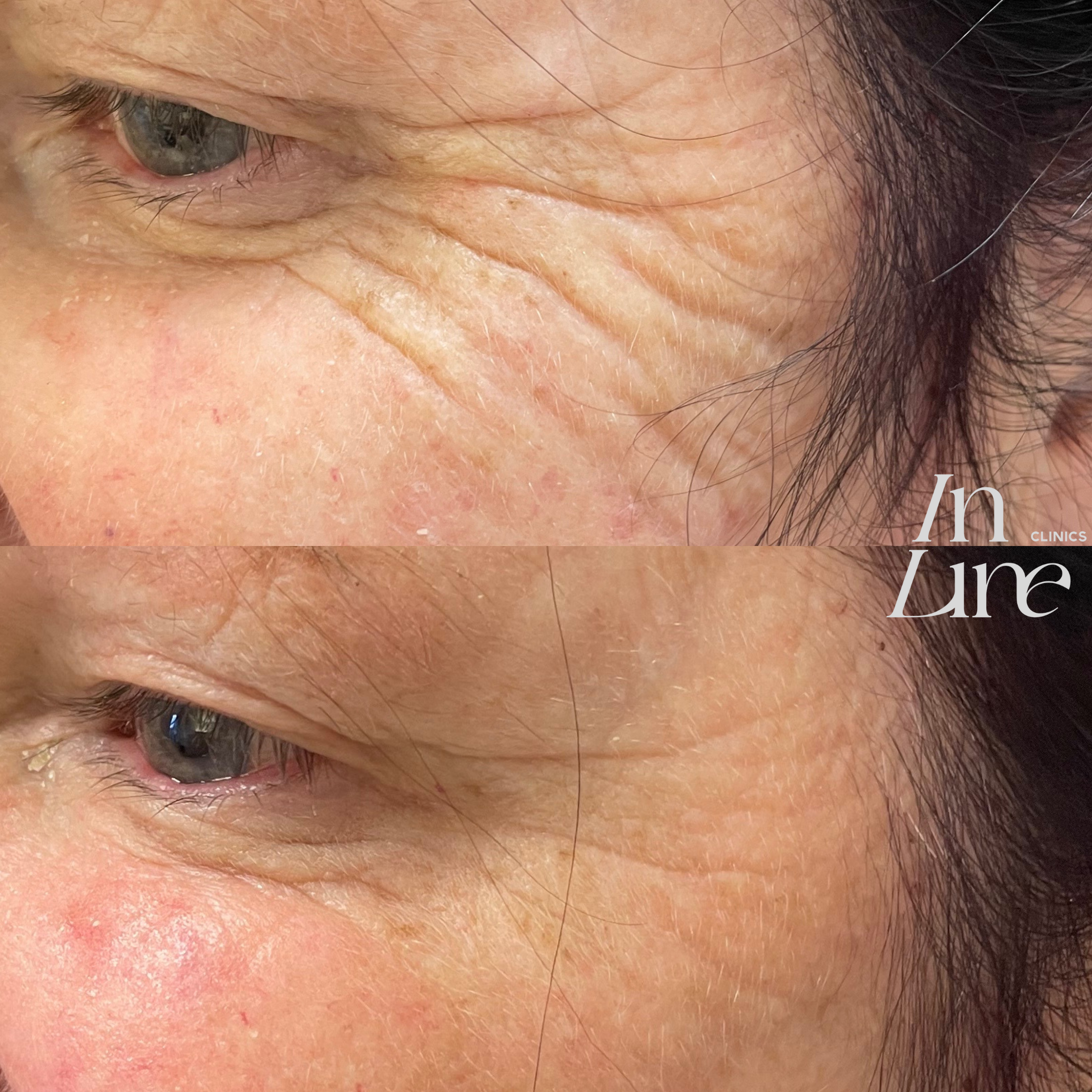 Anti Wrinkle Injection Canberra - Before & After 3