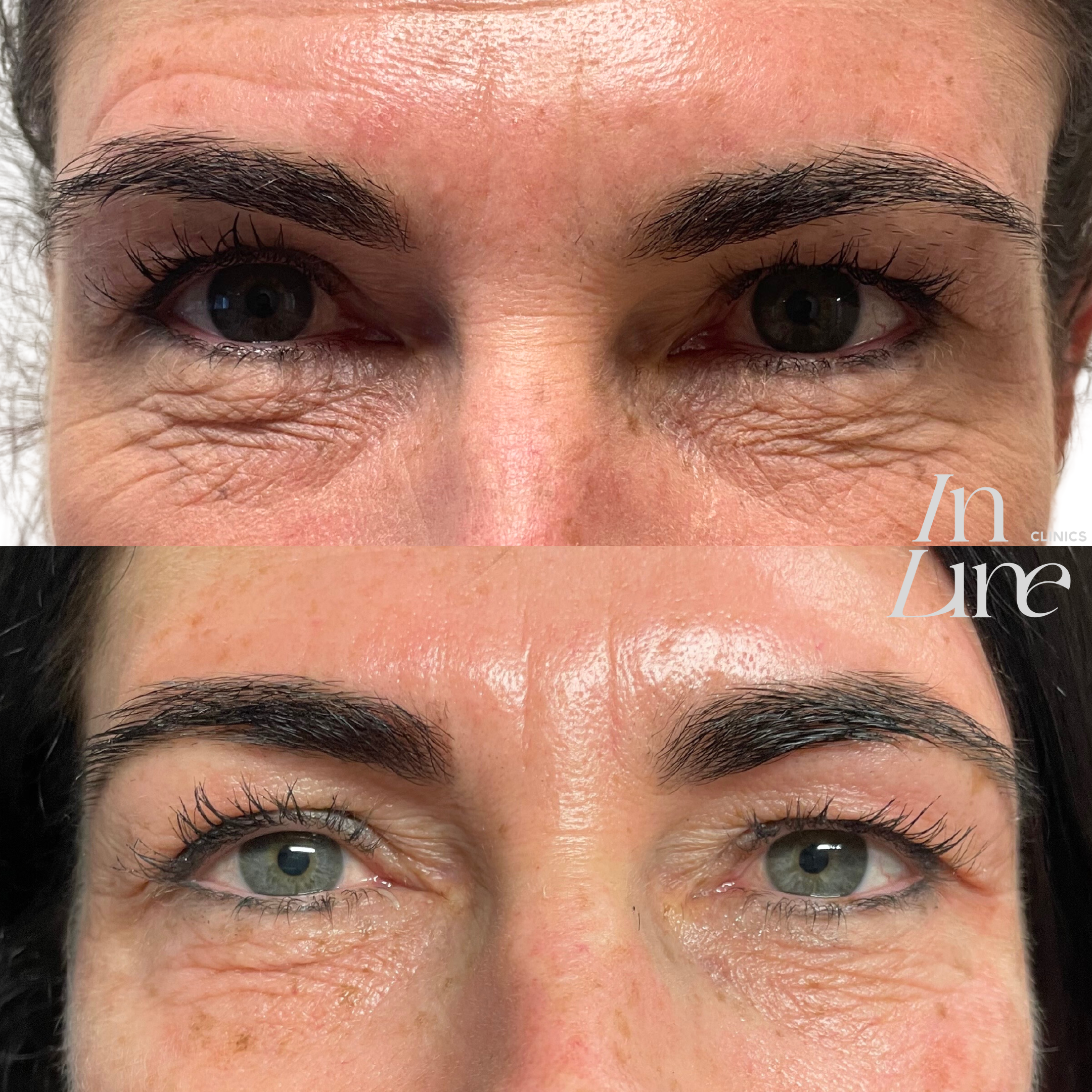 Anti Wrinkle Injection Canberra - Before & After 1
