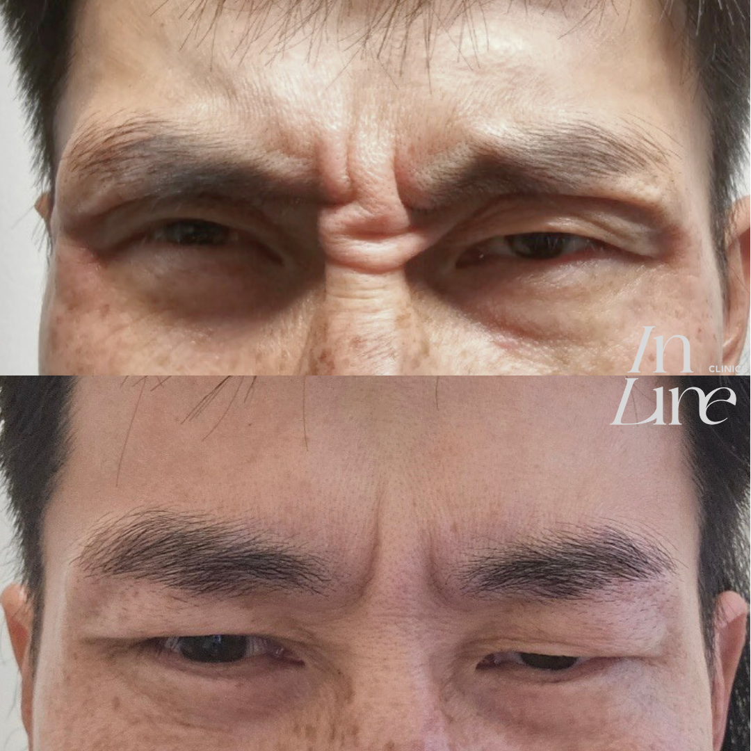 Anti Wrinkle Injection Canberra - Before & After 5