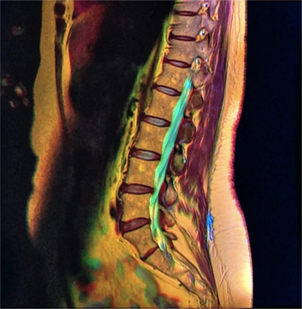 MRI scan of a human spine and lower back.