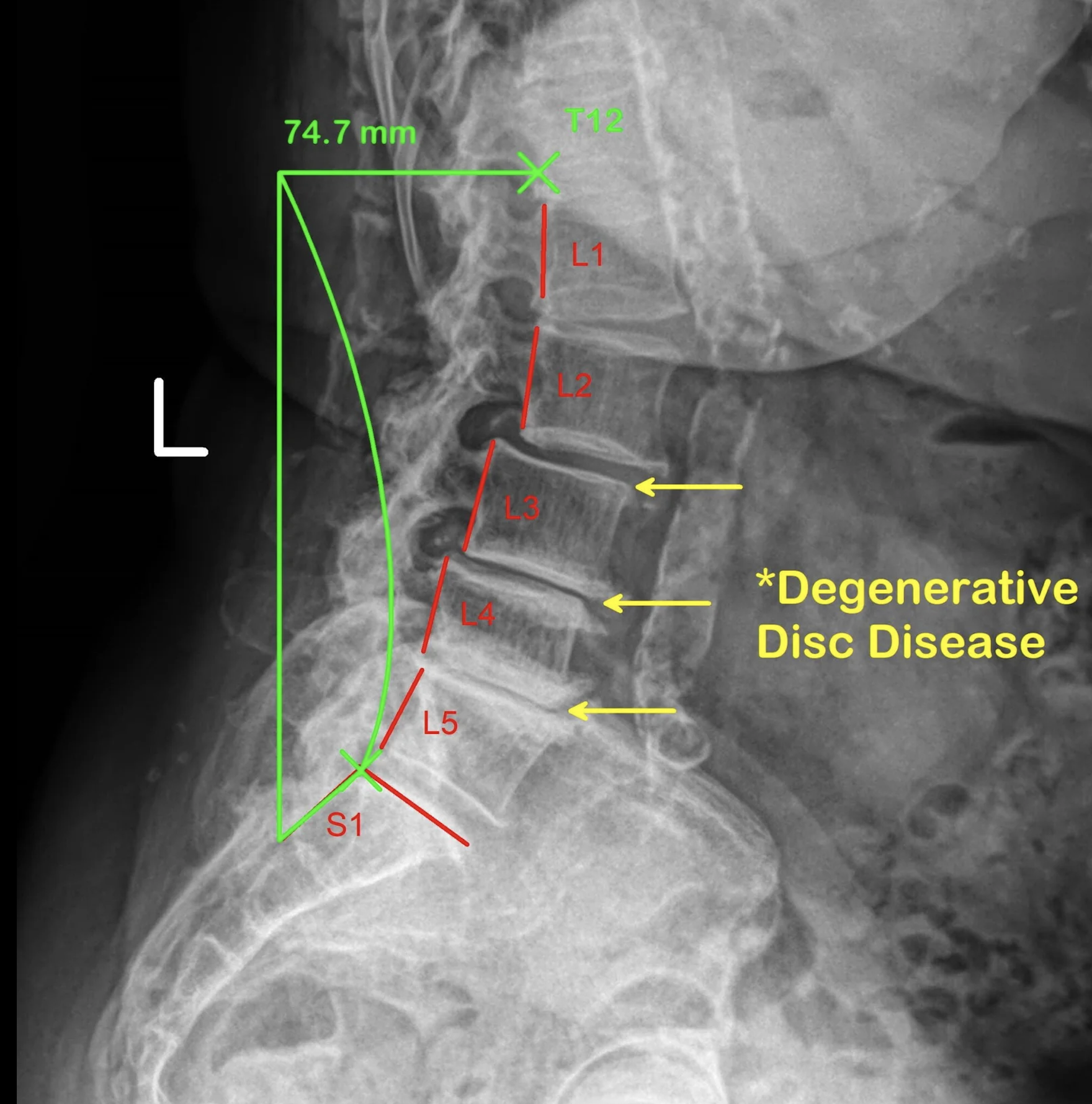 Degenerative Disc Disease (DDD)
