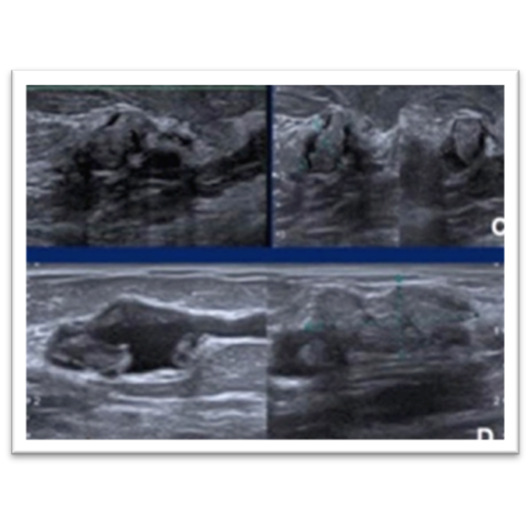 Lesiones benignas simuladoras de Cáncer Mamario: Diagnósticos diferenciales y sus signos ecográficos
