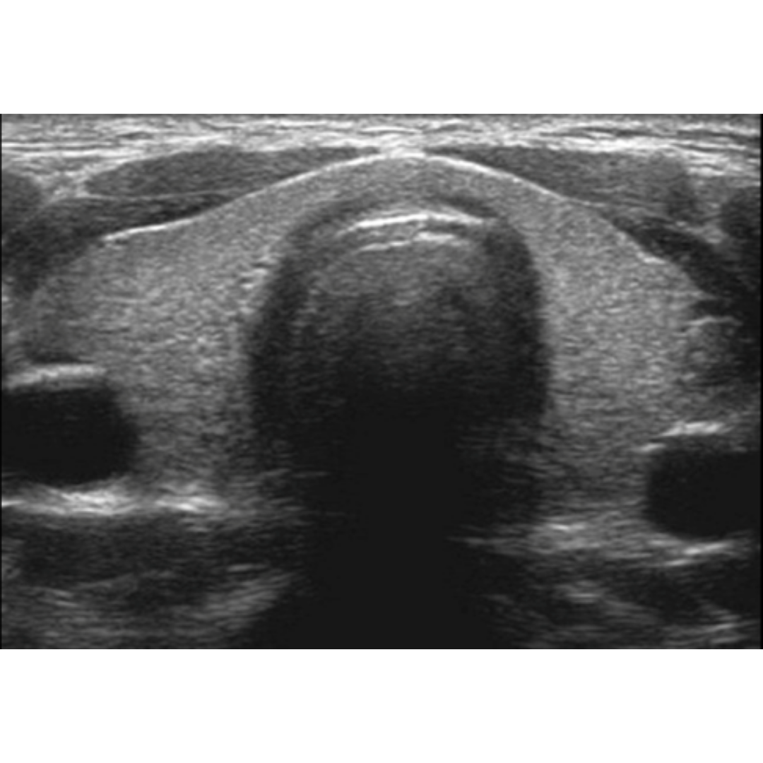 Hiperparatiroidismo Primario: Hallazgos ecográficos esperables