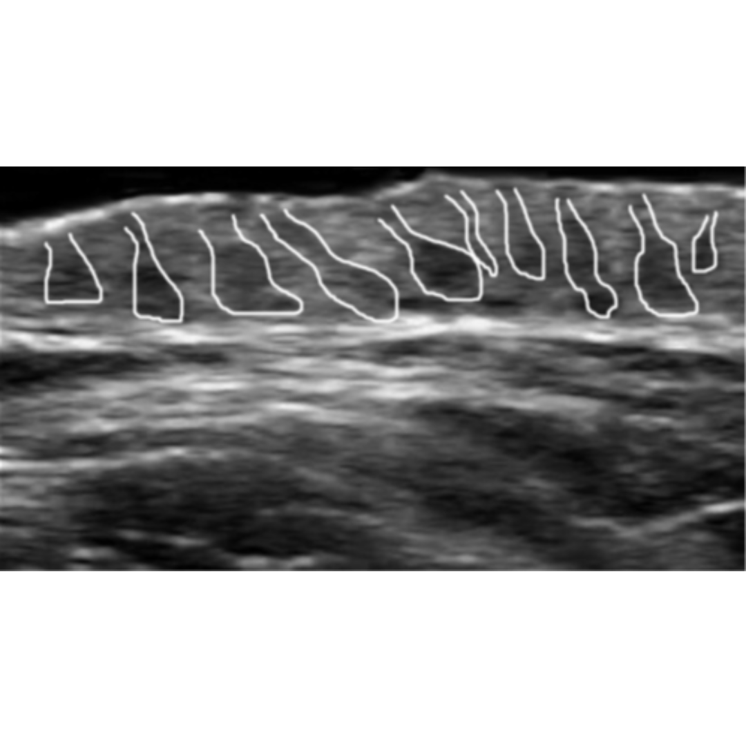 Hidradenitis Supurativa : Revisión de los hallazgos ecográficos y sus clasificaciones