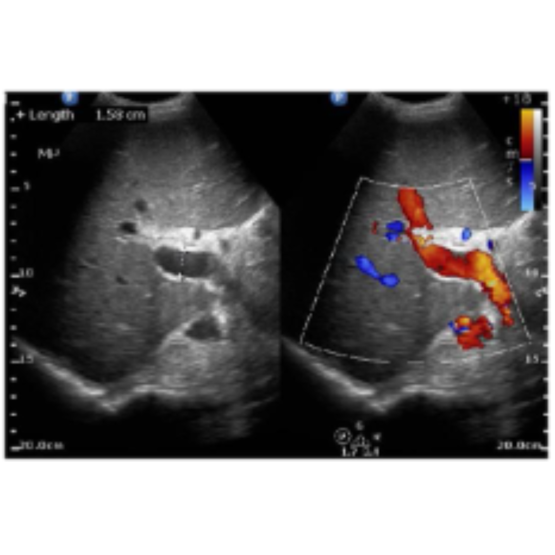 Daño Hepático Crónico: Hallazgos Ecográficos Importantes en Hepatopatía Crónica Parte I