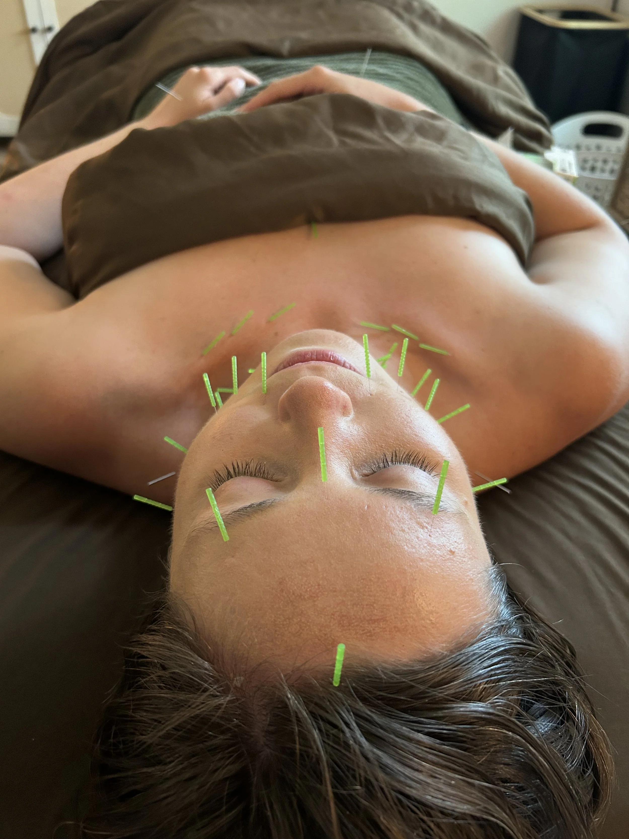Cosmetic Acupuncture vs. Botox &amp; Fillers