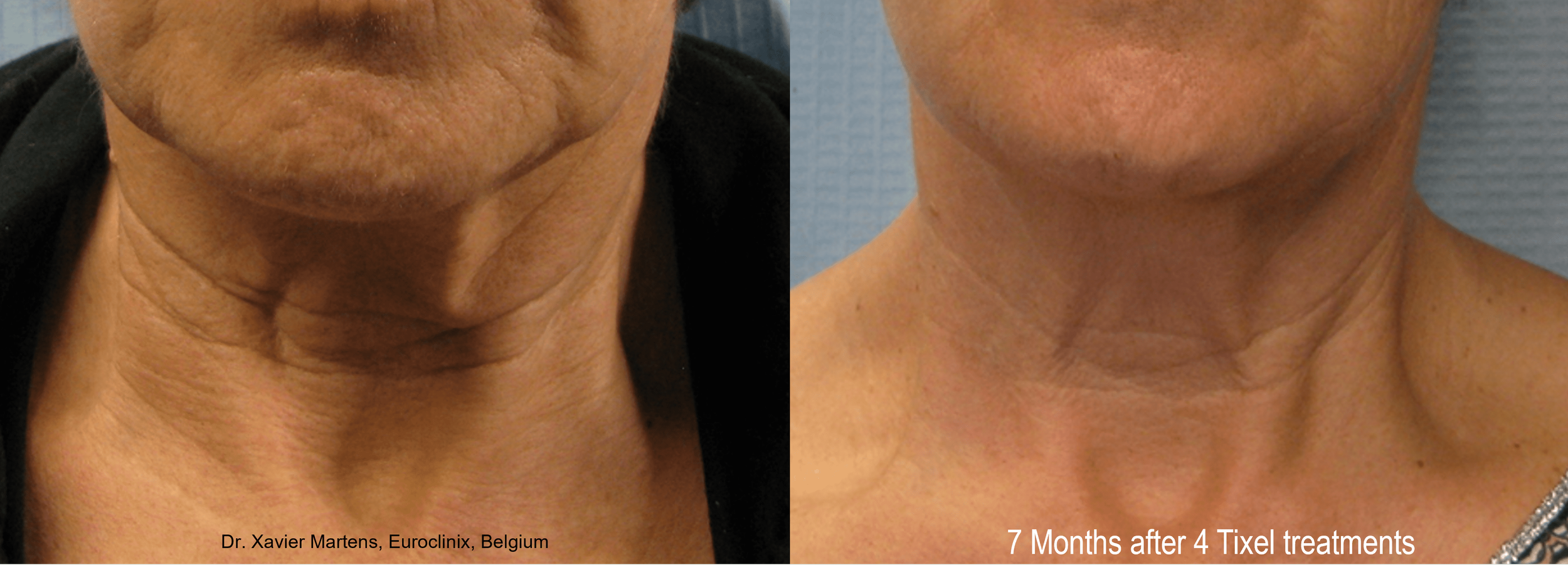 Before and After Tixel skin resurfacing treatment showing improvement in neck skin texture
