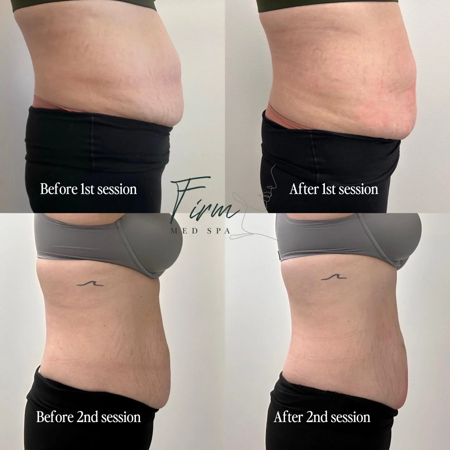 Before and after Evolve X body contouring treatment at Firm Medical Spa in Tulsa