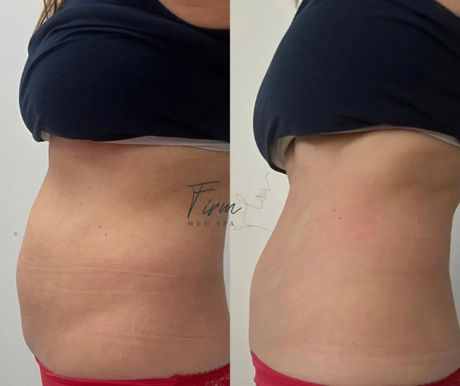 Evolve X body contouring before and after results at Firm Medical Spa in Tulsa.