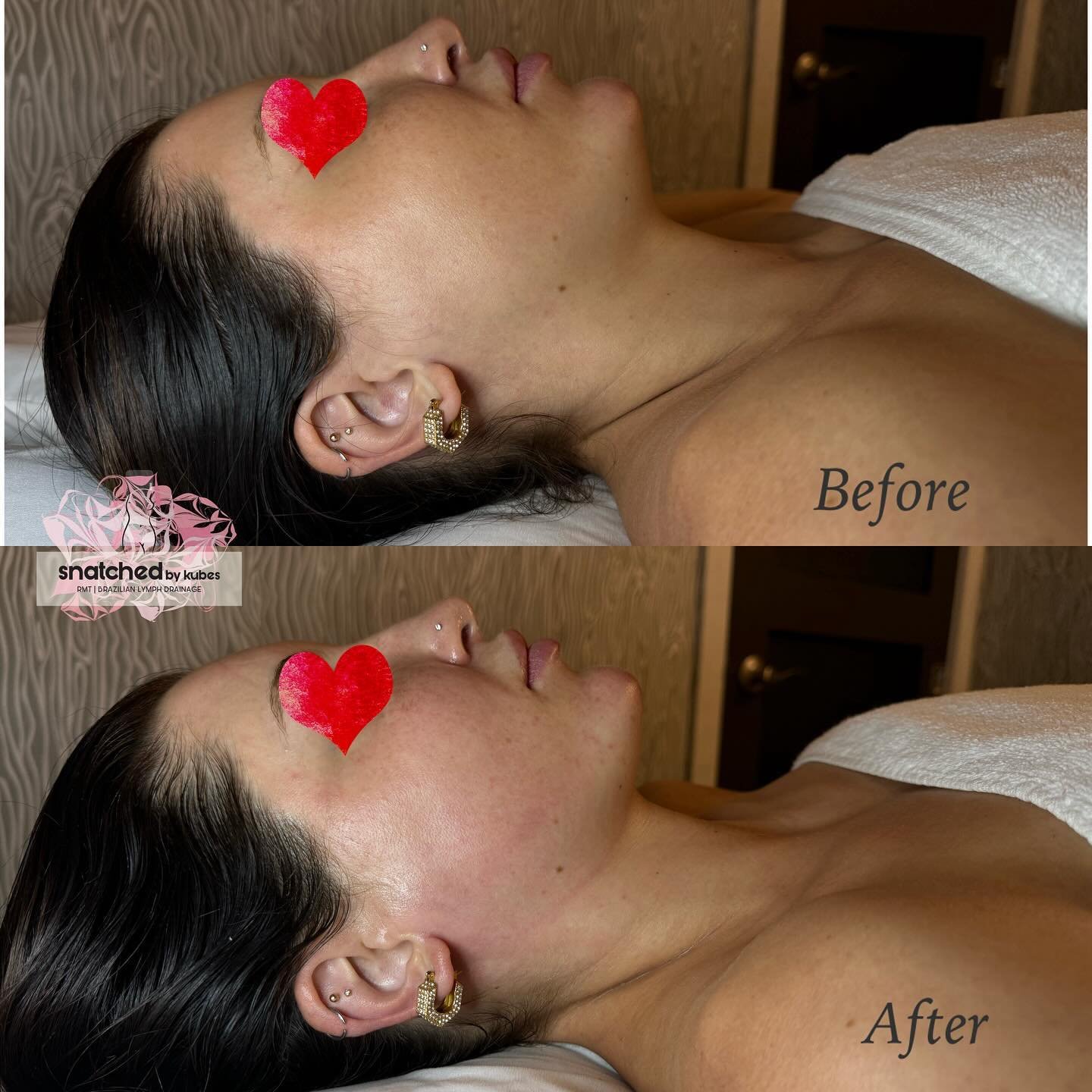 Who doesn&rsquo;t love a good snatch in the jawline and cheeks? 😍 book yours today
