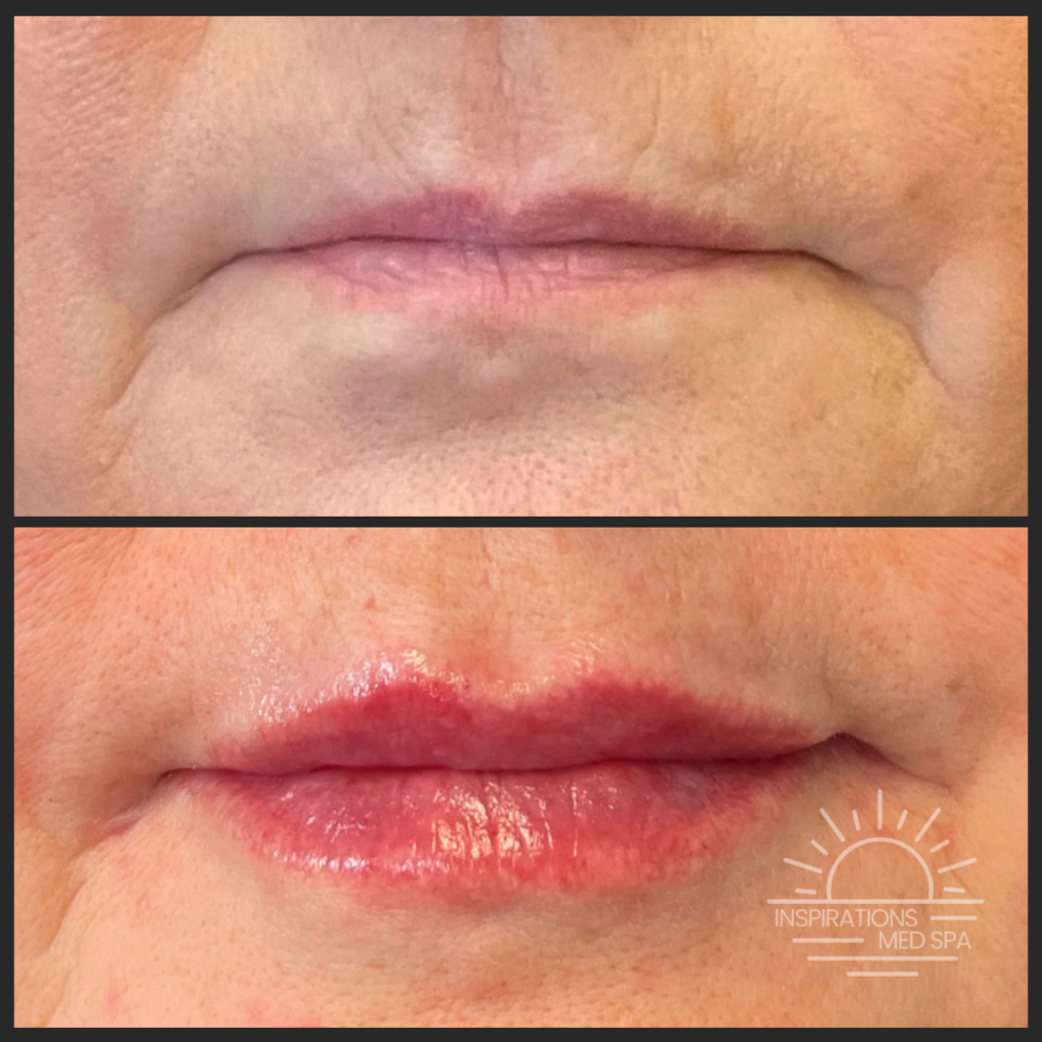 Lip Filler