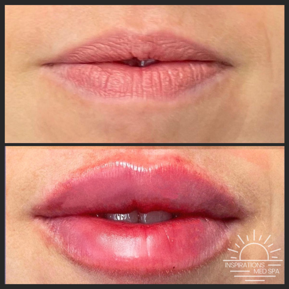 Lip Filler