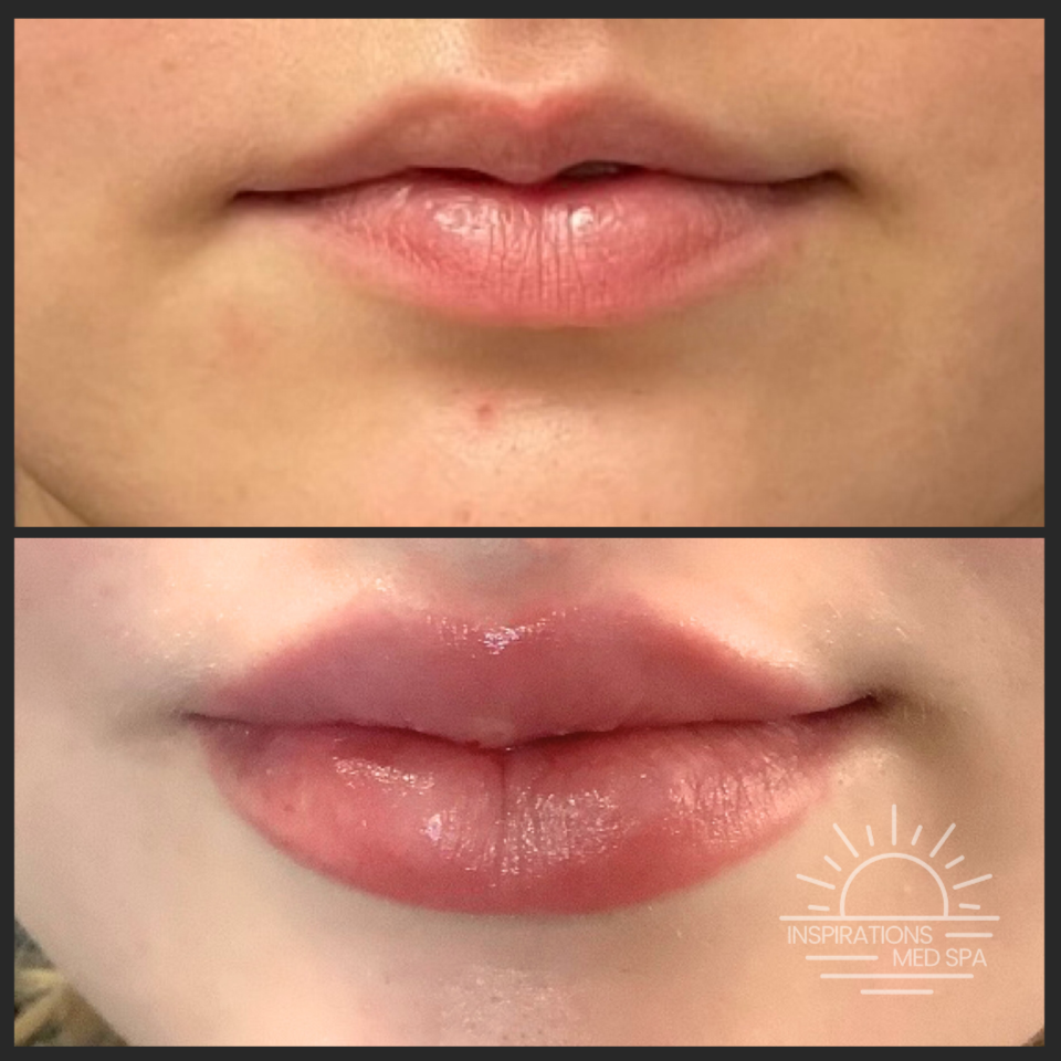 Lip Filler