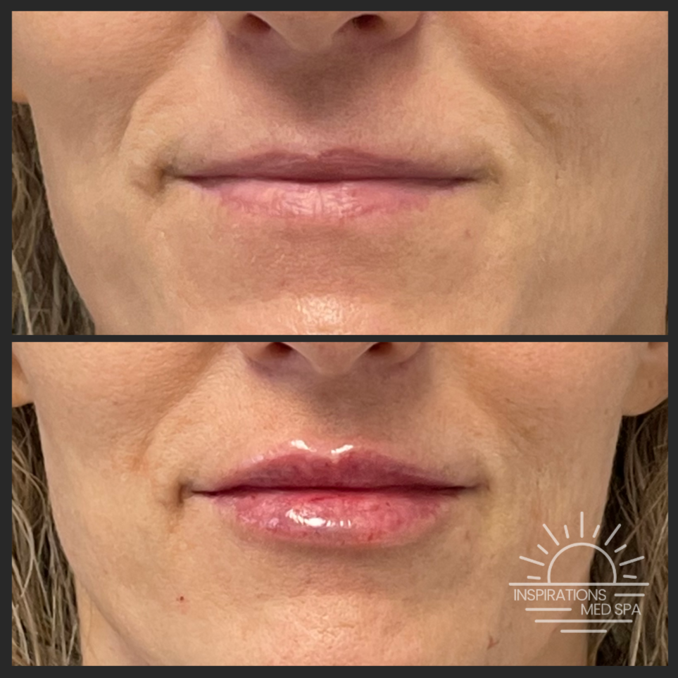 Lip Filler
