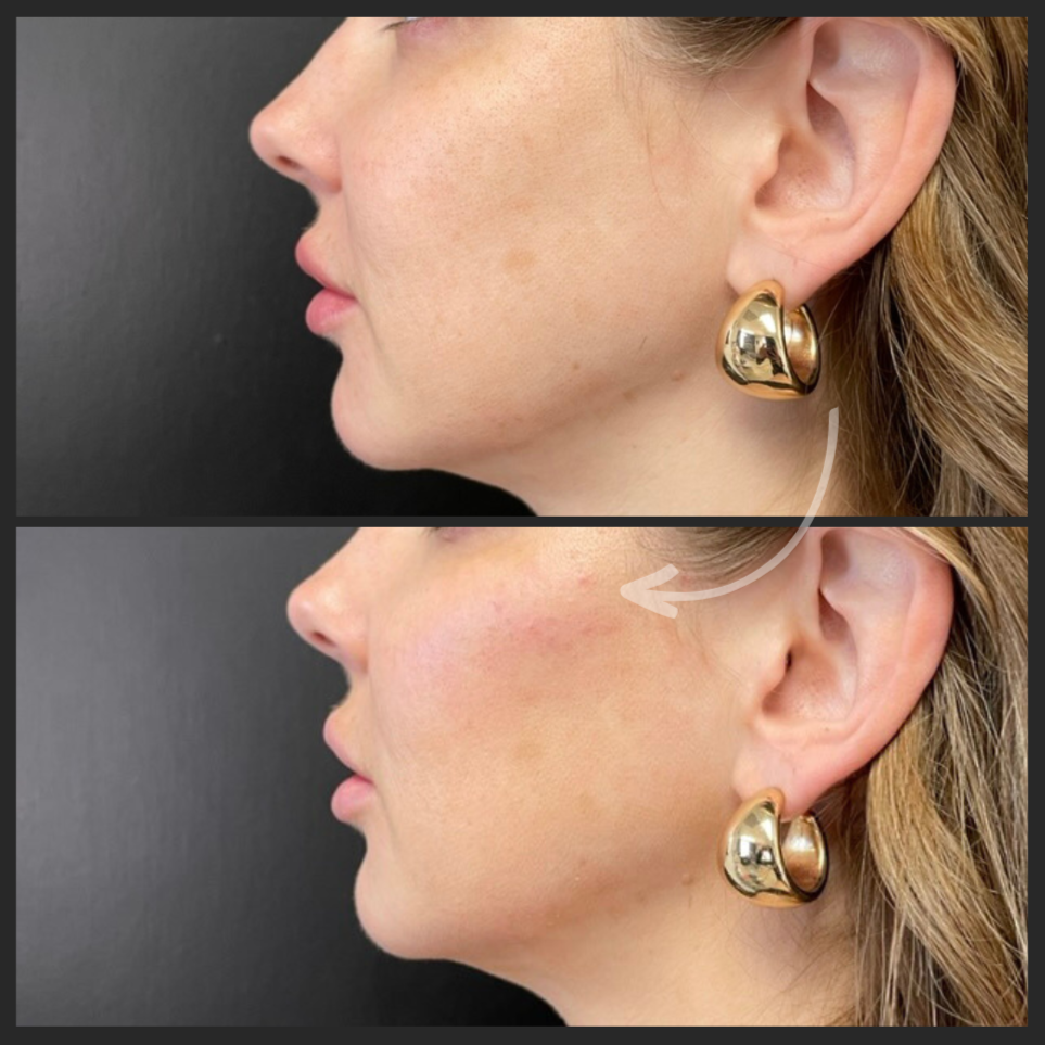 Cheek Filler
