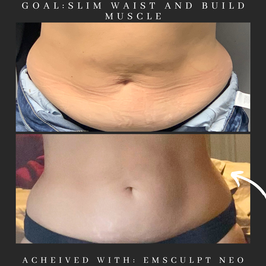 Before and after comparison of a person's abdomen, showcasing results from Emsculpt Neo treatment intended to slim the waist and build muscle.