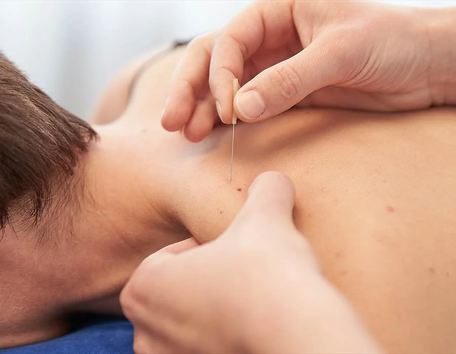 The Magic of Dry Needling