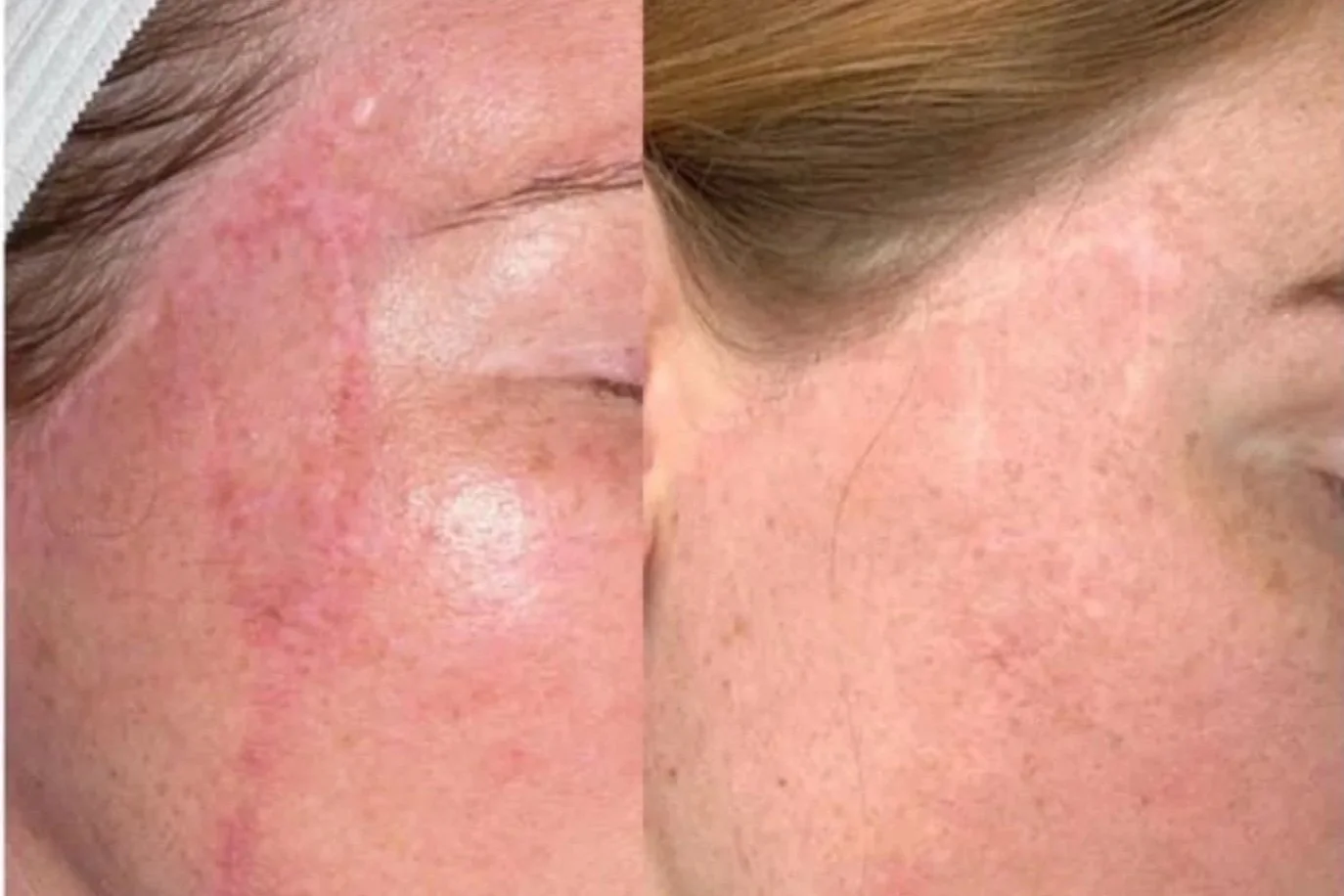 Close-up comparison of a person's face before and after treatment, showing improvement in skin redness and spots.