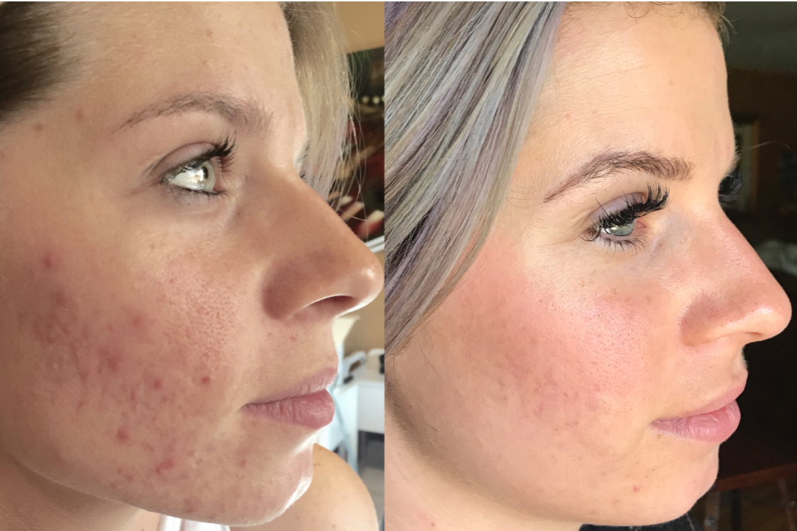 Side-by-side comparison of a woman before and after skin treatment showing clear skin, fewer pimples, and improved complexion.