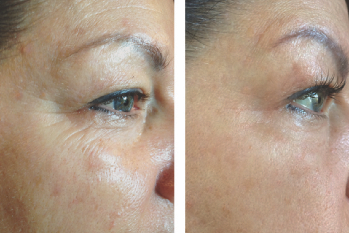 Close-up side view of a woman’s face before and after skincare treatment showing reduced wrinkles and smoother skin.