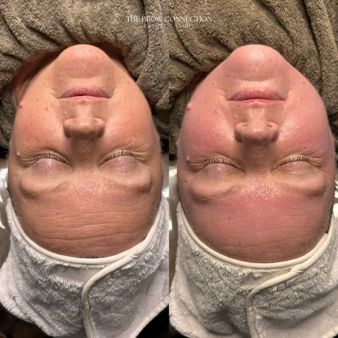 When we say Glassifier Bio Micro-Needling delivers results&hellip; this is exactly what we mean ✨

Just look at how her fine lines have softened, genuinely smoothed with real skin regeneration.

This client wanted fresher, brighter, more refined skin
