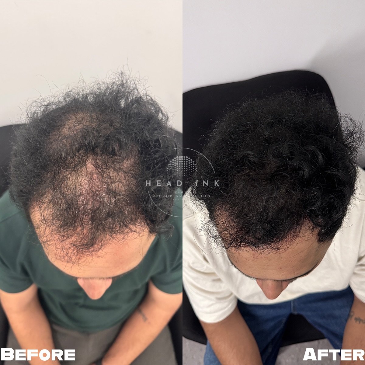 From thinning to thickening✨

This client came to us feeling less confident as hair thinning started to show more gaps on the scalp. After his SMP density treatment, those gaps are gone and his confidence is back.

A fuller look, a cleaner hairline, 