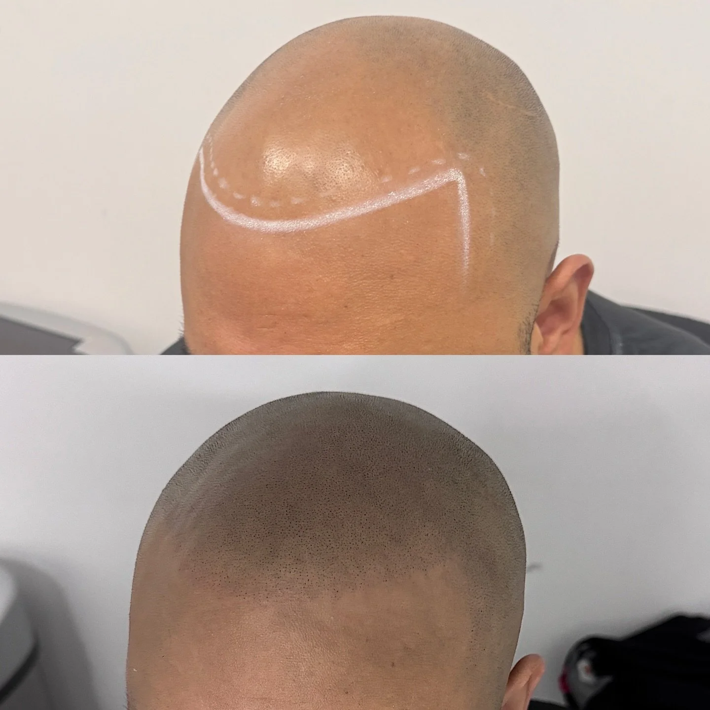 Before and after Scalp Micropigmentation 
Natural hairline requested

For years, he hadn&rsquo;t seen a real hairline looking back at him in the mirror. Bit by bit, his confidence faded along with it.

Today&hellip; that changed.
After completing his