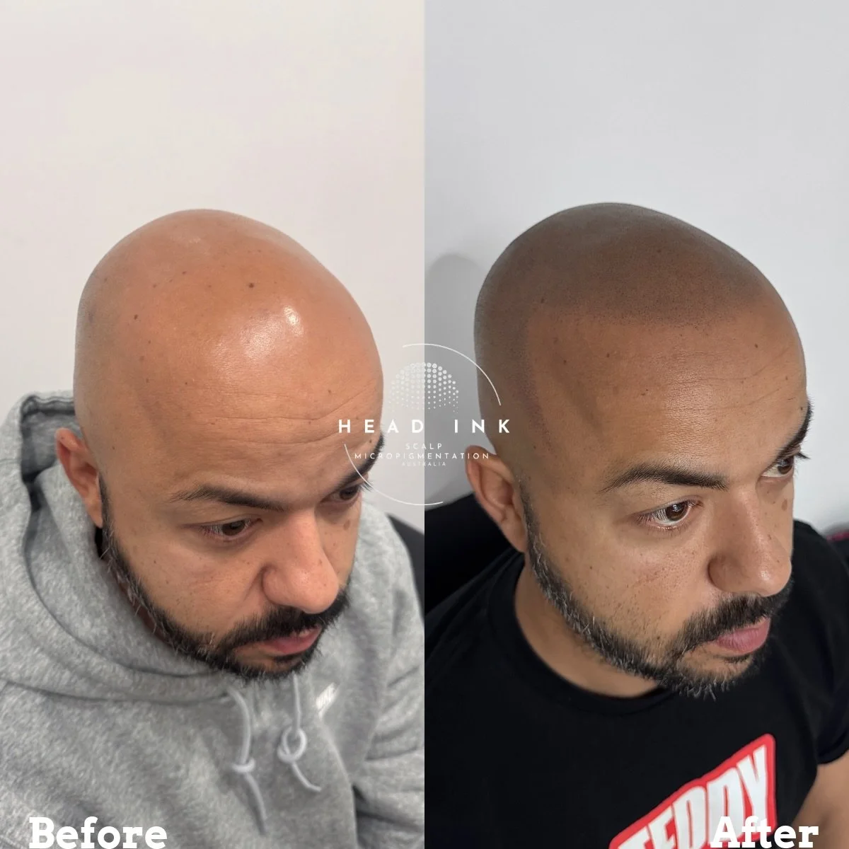 10+ Years of Hair Loss GONE with Micropigmentation Transformation ✨

What an incredible transformation for this client! Look at before and after of his Scalp Micropigmentation (SMP) treatment on the shaved look.

Dealing with over a decade of hair lo
