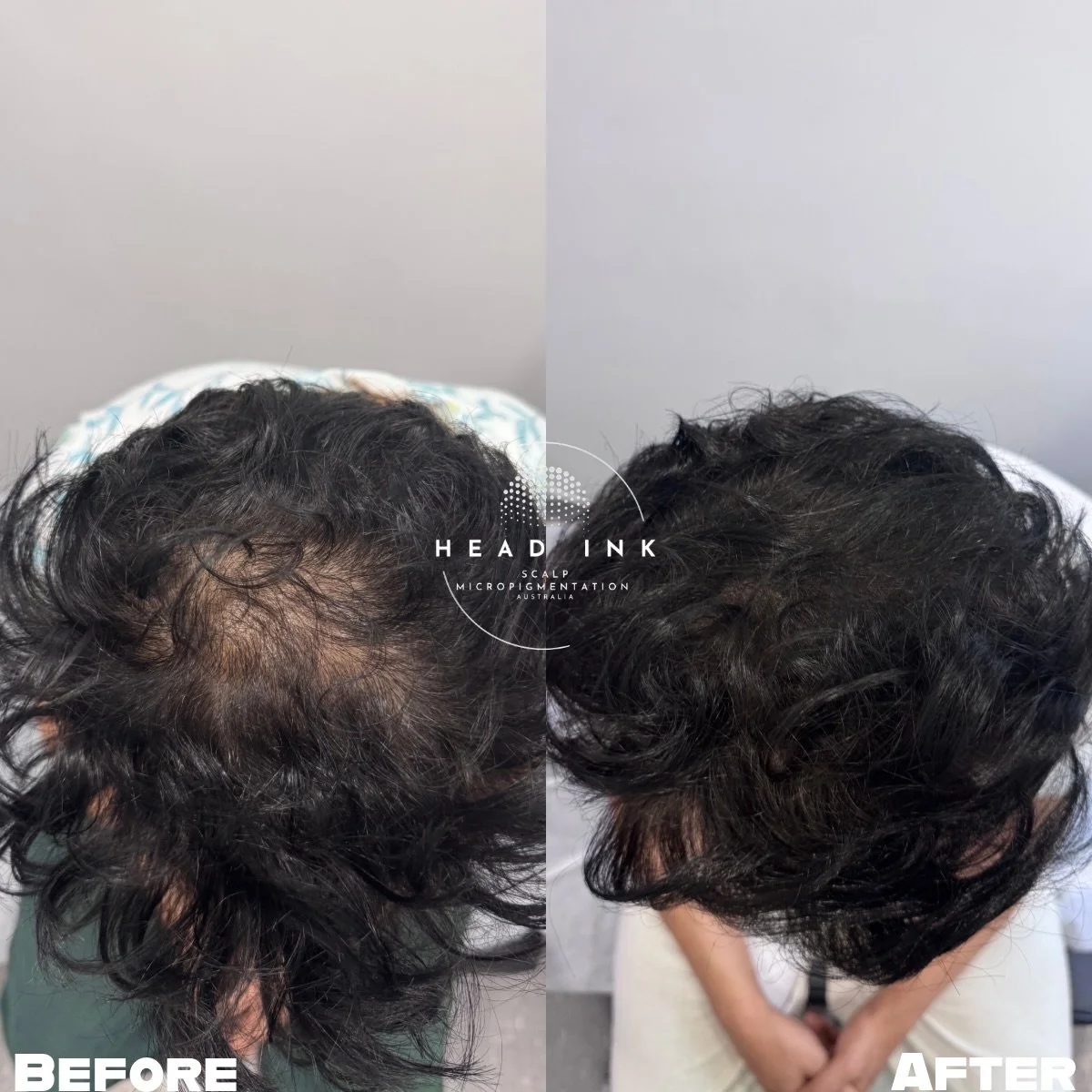 THE CROWN COMEBACK! 👑✨

The crown area is often the biggest source of stress for our clients. It&rsquo;s that constant worry about who is standing behind you or how your hair looks under overhead lights. For this legend, that self-consciousness was 