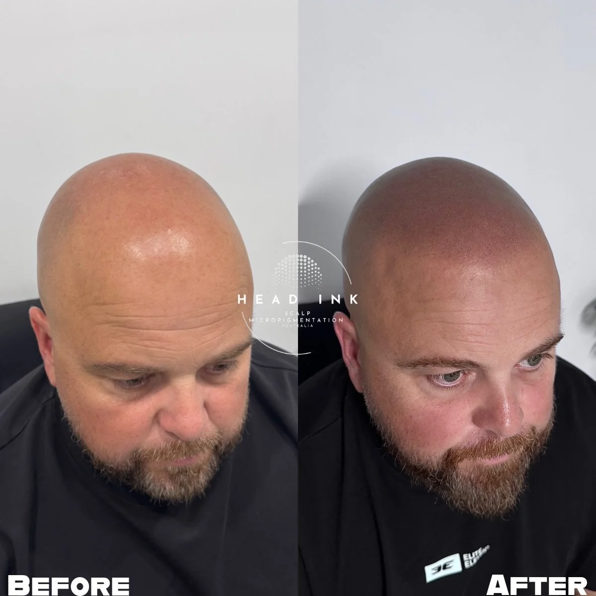 YEARS OF THINNING&mdash;GONE IN A FEW SESSIONS. 📈✨

This is why we do what we do. This legend has been experiencing thinning hair for many years, eventually leading to a completely bald scalp on top. It&rsquo;s a long road that can really take a tol