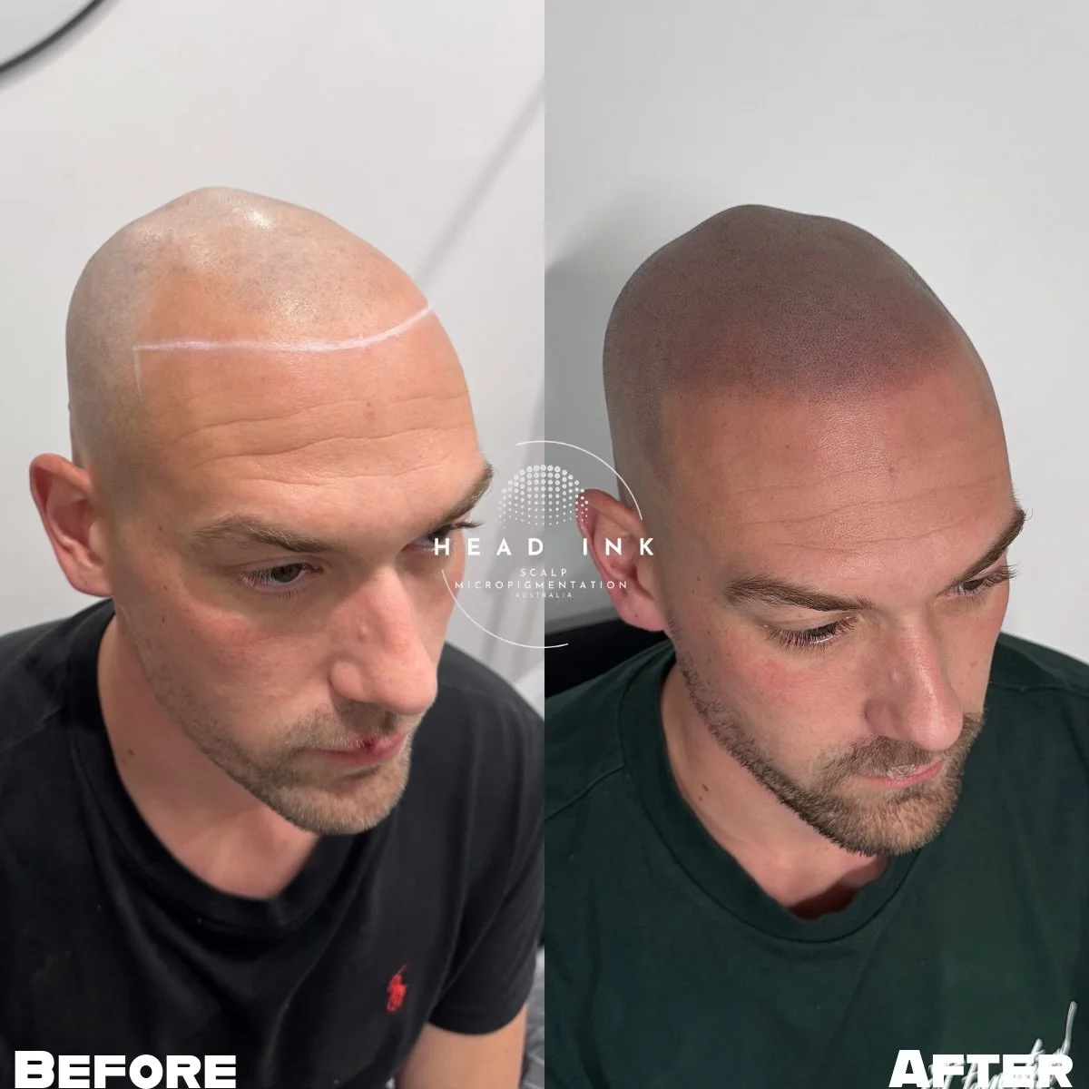 FROM RECEDING TO RESTORED. 📐✨

Check out the difference a bespoke hairline makes! This legend came to us with a receding hairline and thinning throughout the top of his scalp. He was tired of trying to hide the thin spots and was ready for a look th
