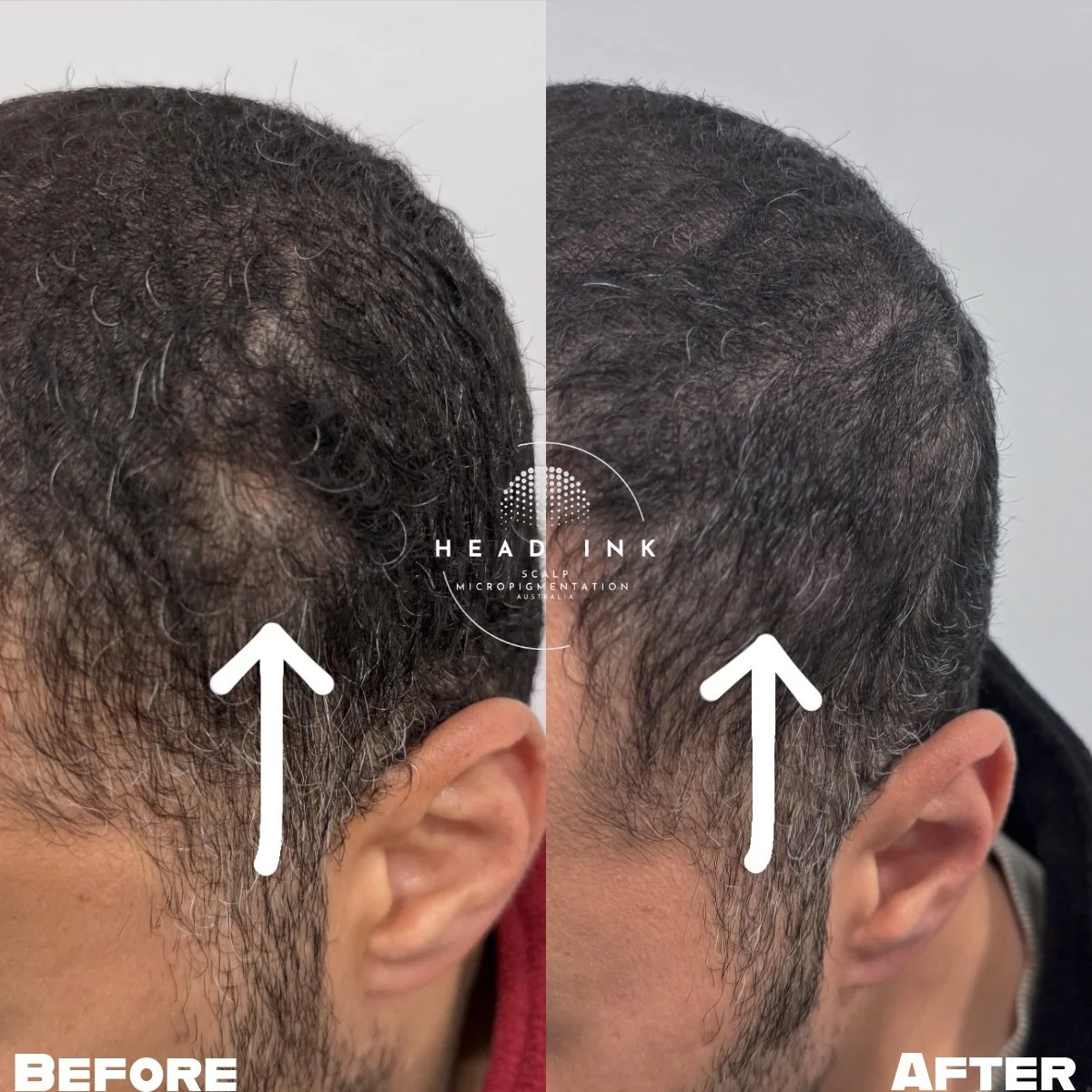NOW YOU SEE IT, NOW YOU DON&rsquo;T. 🔎✨

Scars from past injuries or surgeries can often leave a &ldquo;gap&rdquo; where hair simply won&rsquo;t grow back. For this legend, a scar on the side of his head was making it impossible to get a seamless fa