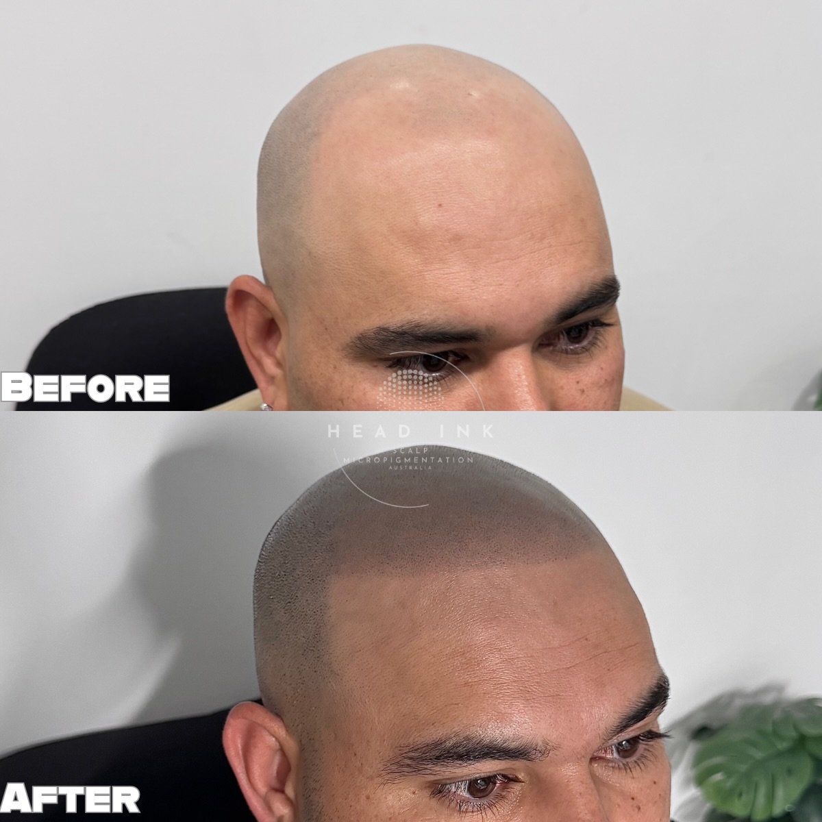 THE POWER OF THE SHARP LINE 📐✨

This result highlights a bold, sharp hairline specifically requested by the client to achieve a high-definition look. While a feathered, soft hairline is a popular choice, a crisp and structured edge provides that &ld