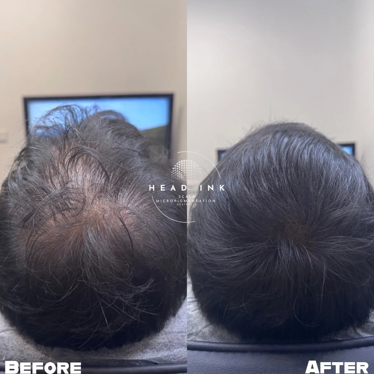 THE DENSITY DIFFERENCE ✍️✨

This specific transformation highlights a client who had been experiencing thinning for many years. The goal wasn&rsquo;t to change his hairstyle, but to reinforce it. Our scalp micropigmentation treatmemt focuses on creat
