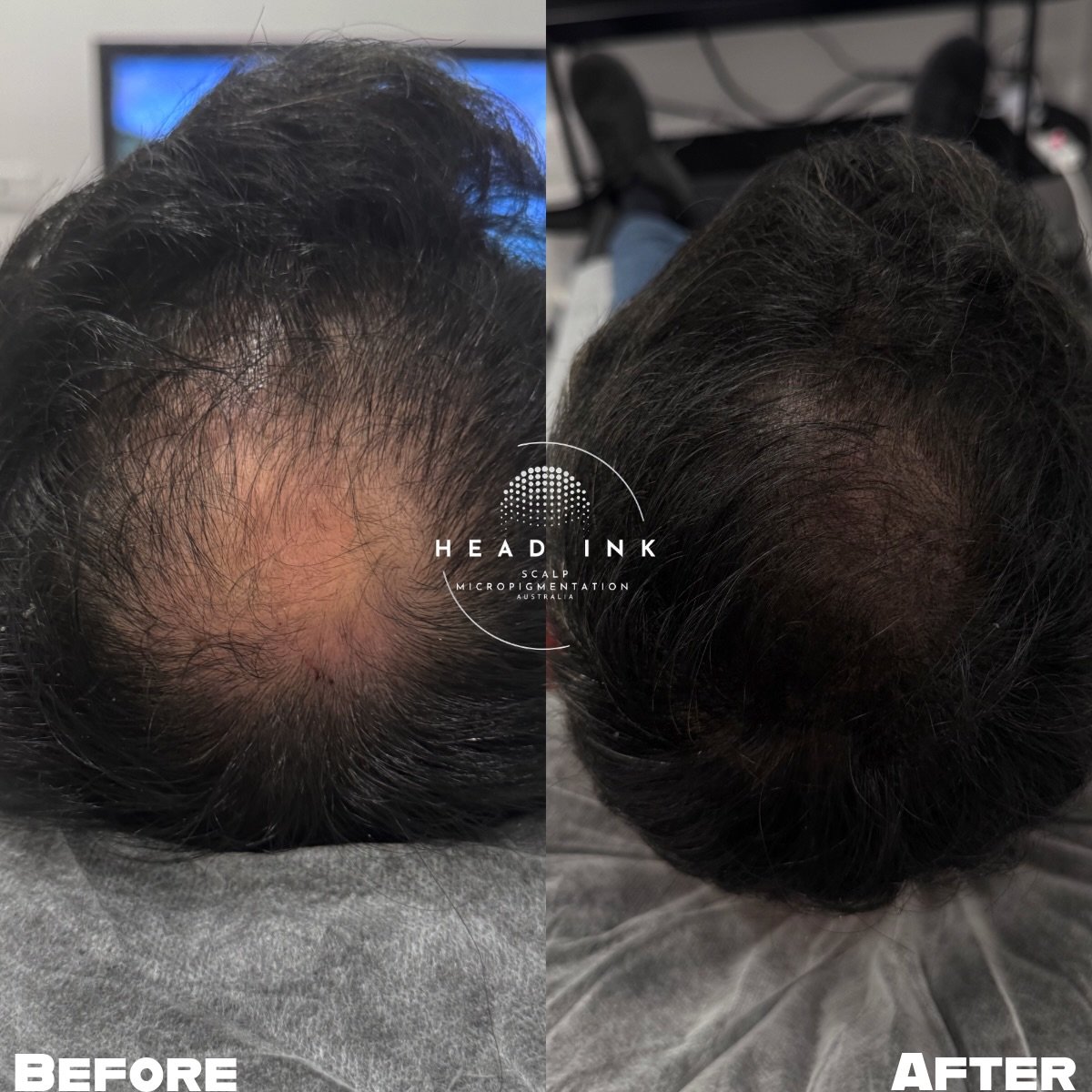WHO&rsquo;S STANDING BEHIND YOU? 

For many guys, the crown is the most frustrating area to lose. You can&rsquo;t see it easily, but you know it&rsquo;s there. This legend was tired of the severe thinning taking over his profile, so he decided to get